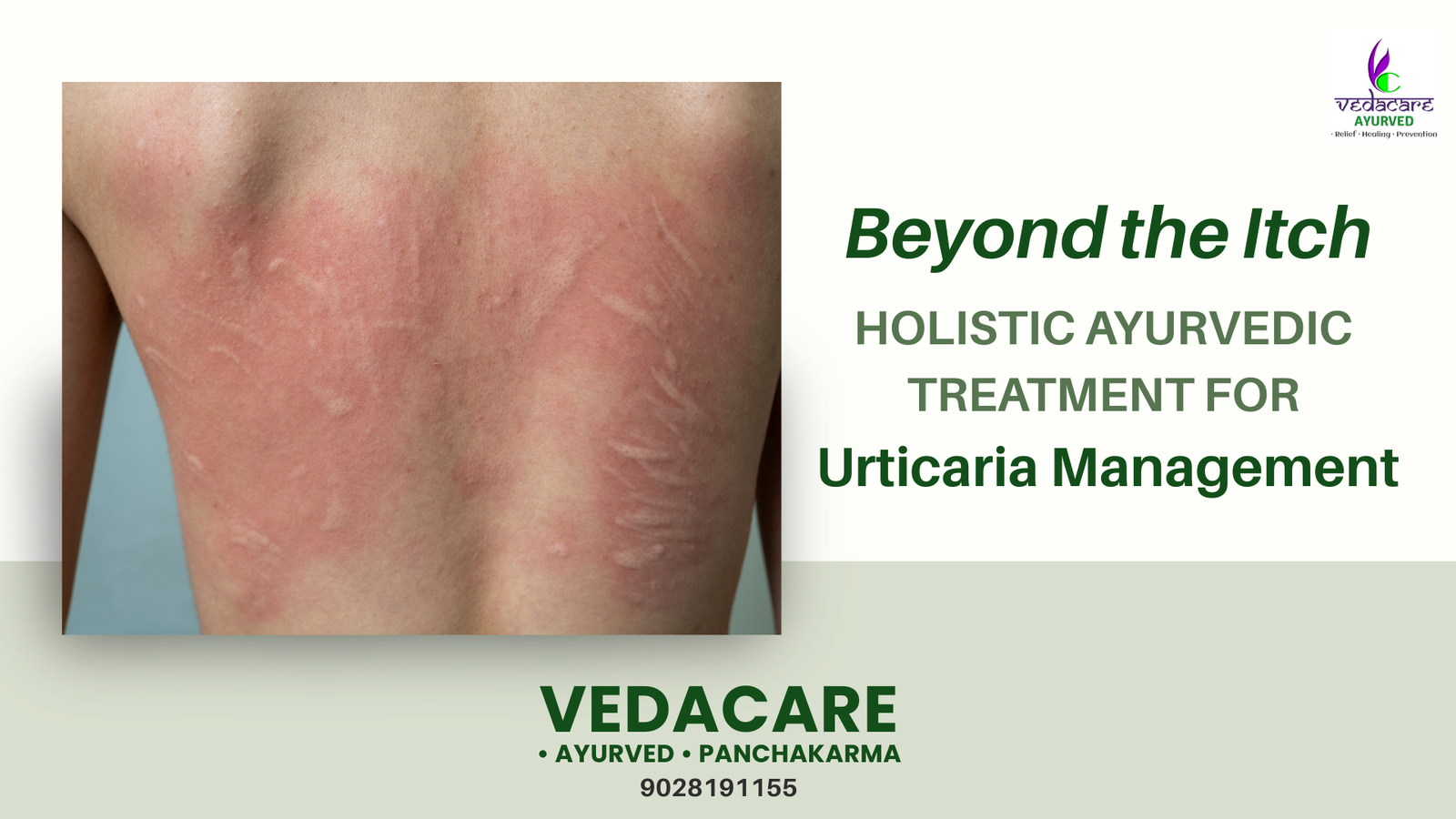 Best Ayurvedic Treatment for Urticaria | Cure Hives Naturally