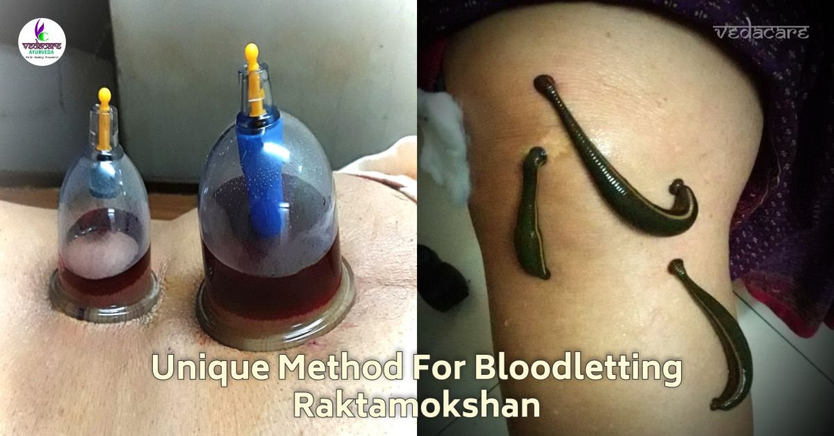 Ayurvedic Raktamokshan therapy with leeches, cupping Blood detox