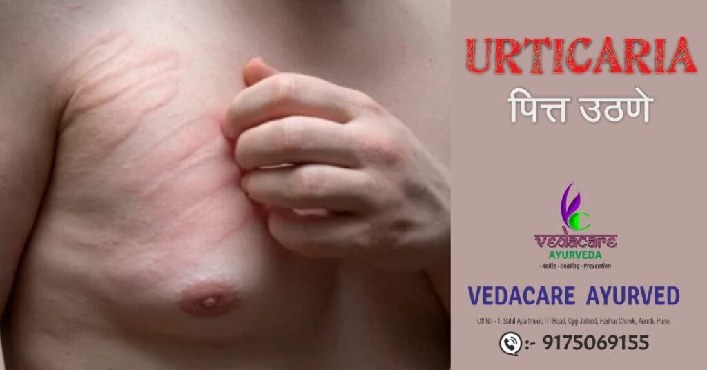 Ayurvedic consultation and herbal treatment for urticaria hives at Vedacare